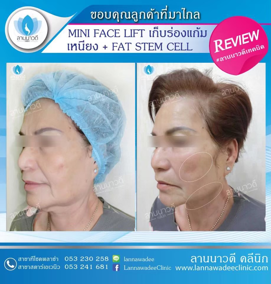 ฉีดไขมันหน้าเด็ก