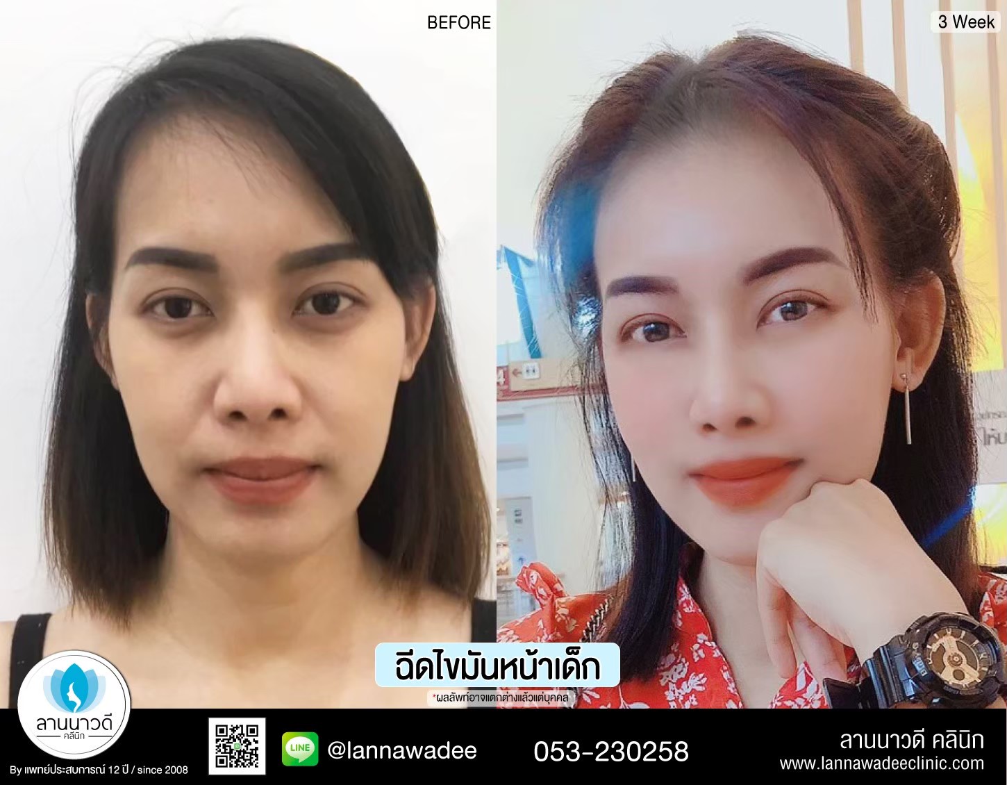 ฉีดไขมันหน้าเด็ก