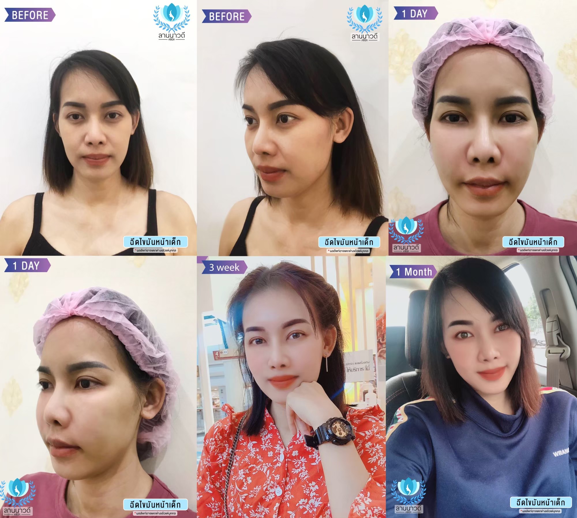 ฉีดไขมันหน้า