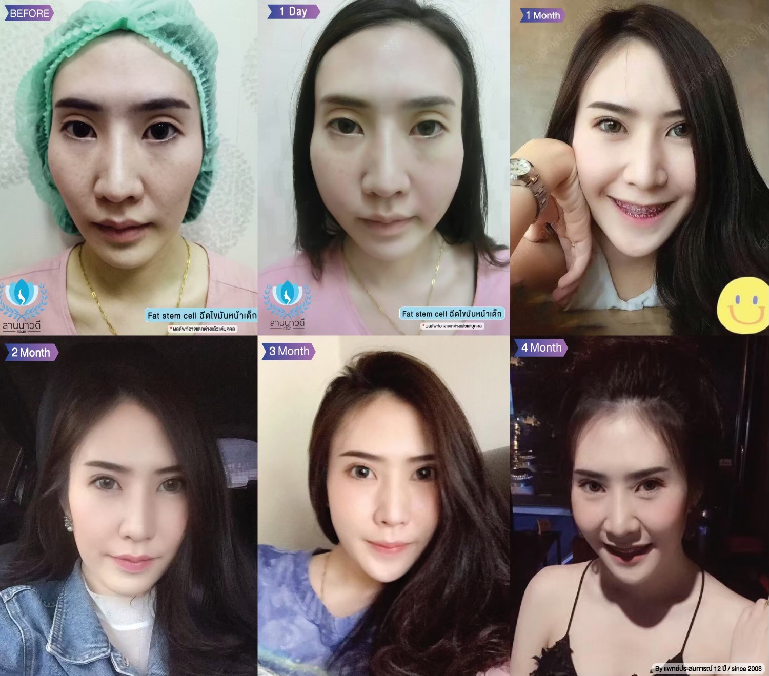 เติมไขมันหน้า