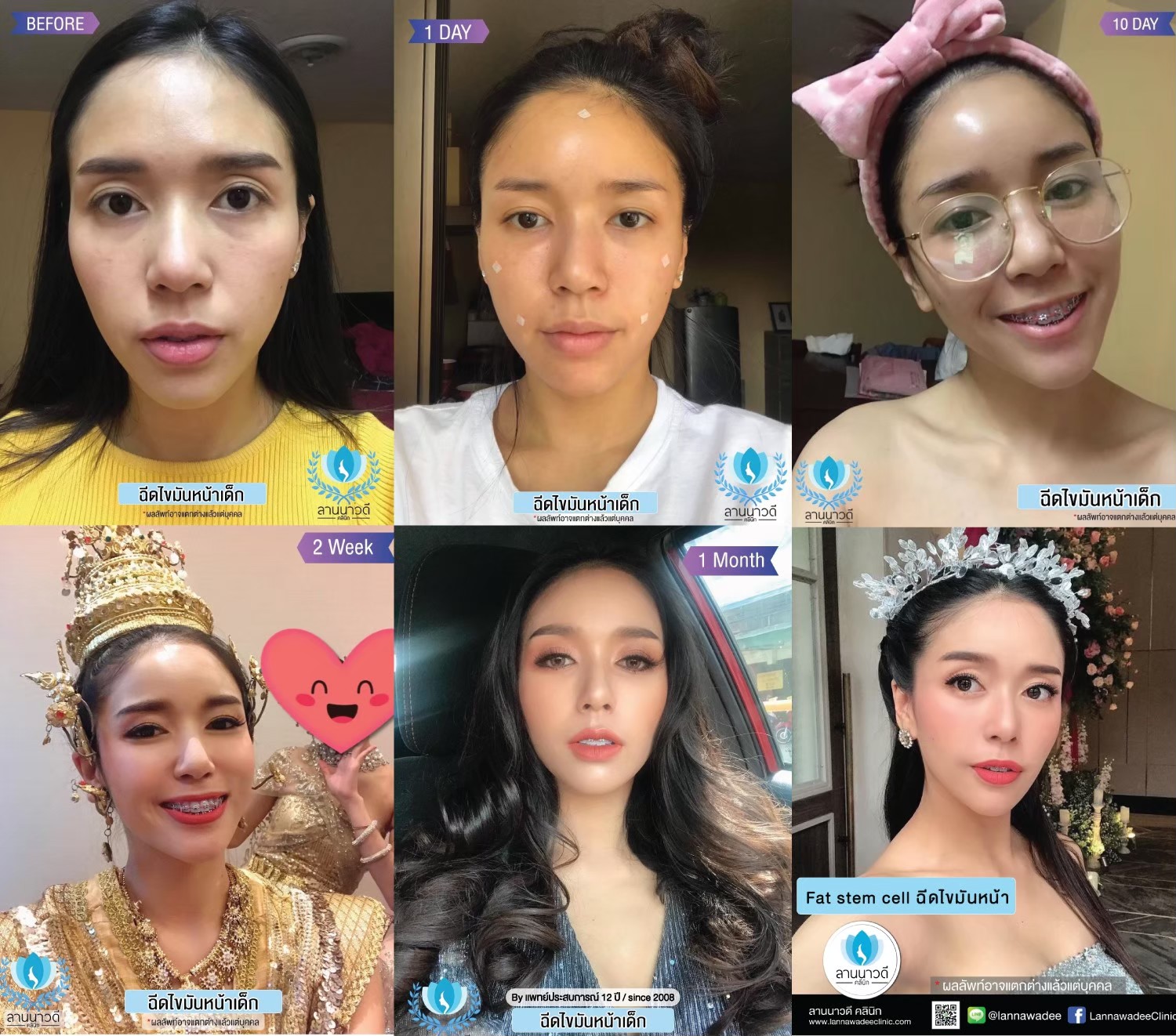 ฉีดไขมันหน้าเด็ก