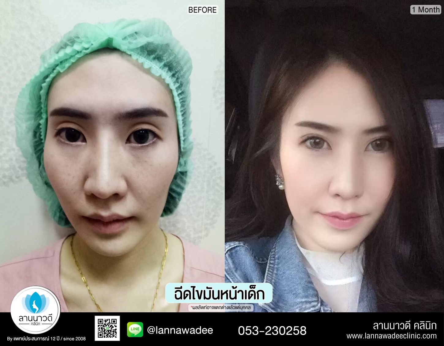 ฉีดไขมันหน้าเด็ก