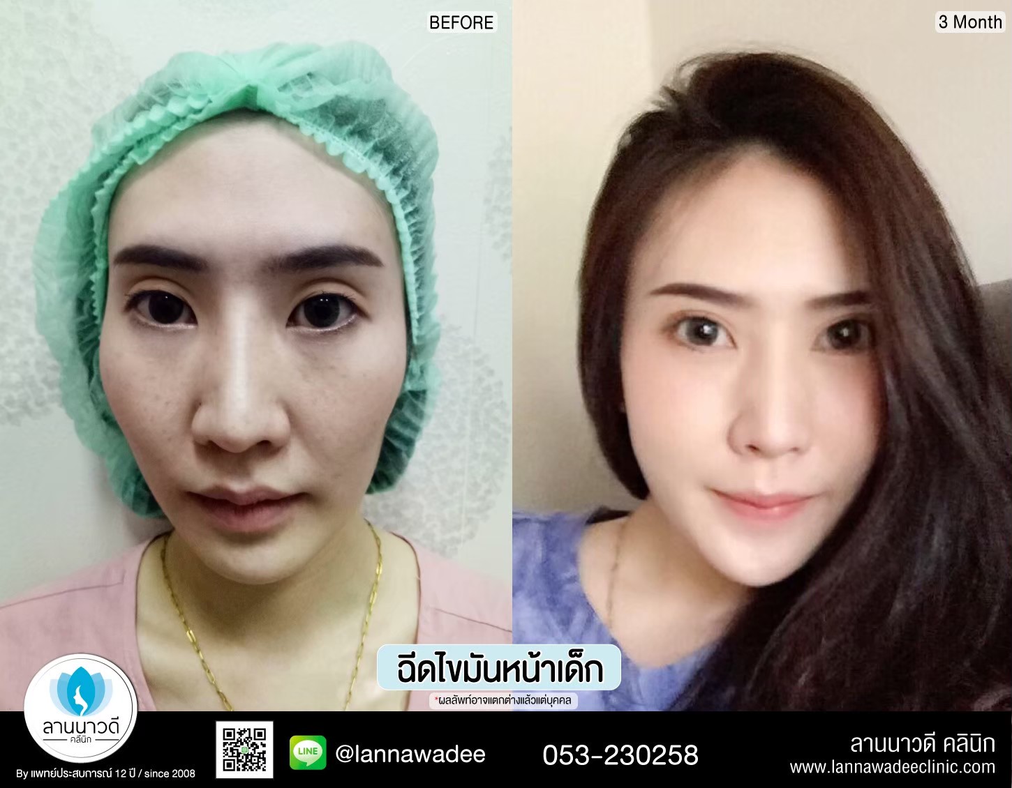 ฉีดไขมันหน้า