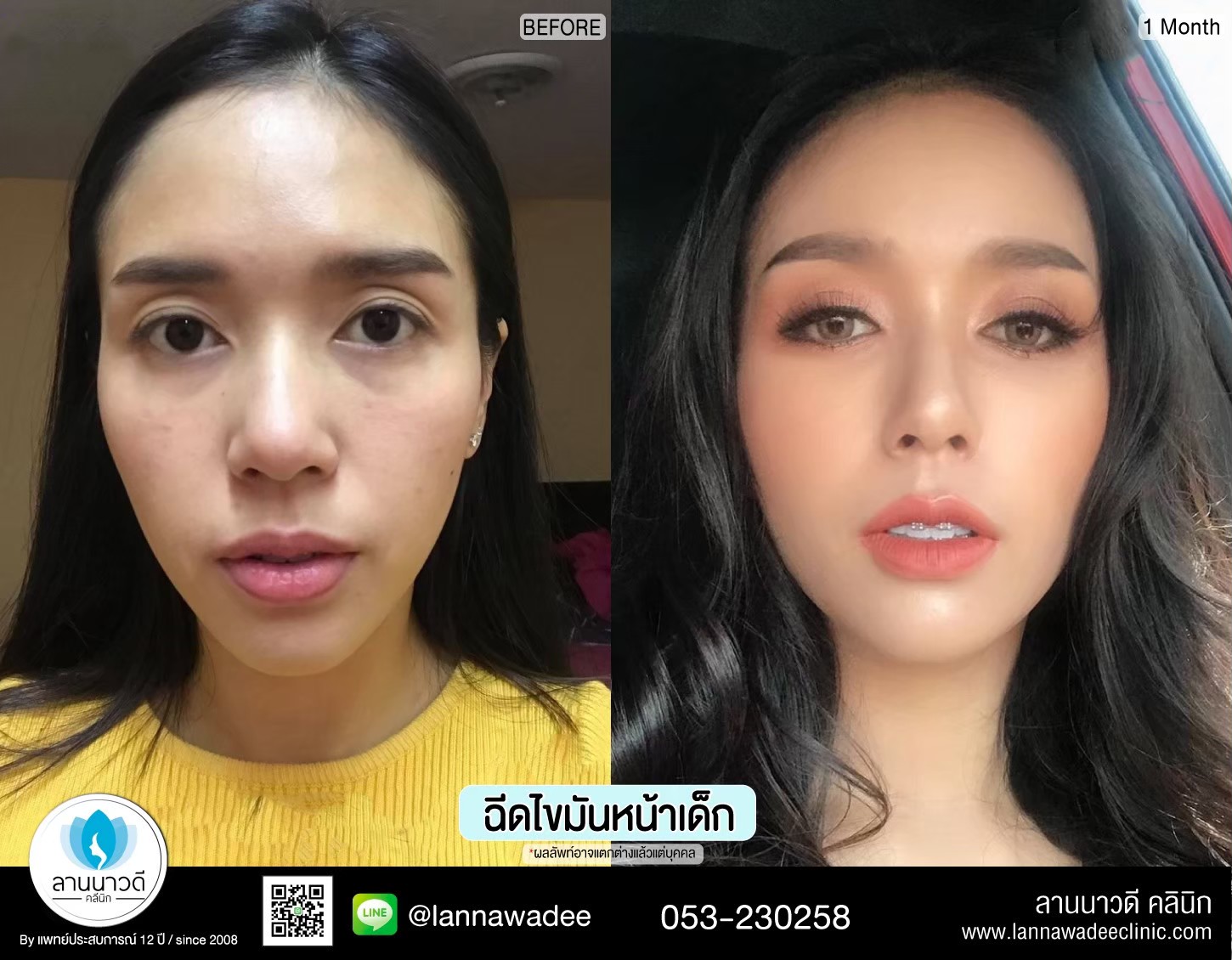 เติมไขมันหน้า
