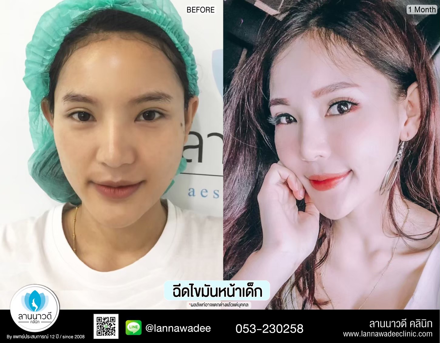 ฉีดไขมันหน้า
