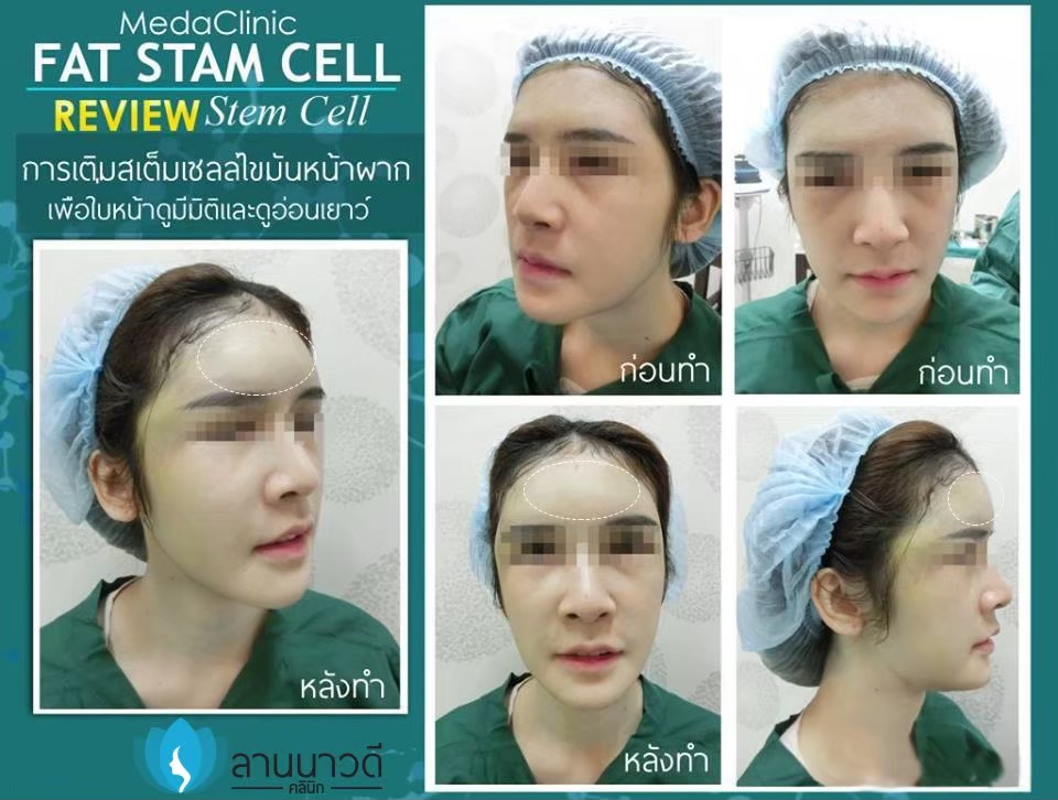 ฉีดไขมันหน้า