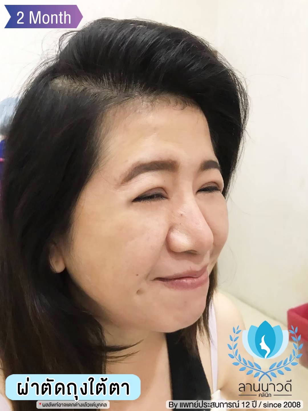 ผ่าตัดถุงใต้ตา