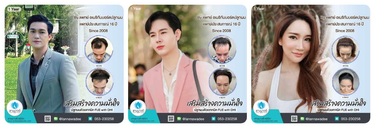 ปลูกผม-เชียงใหม่