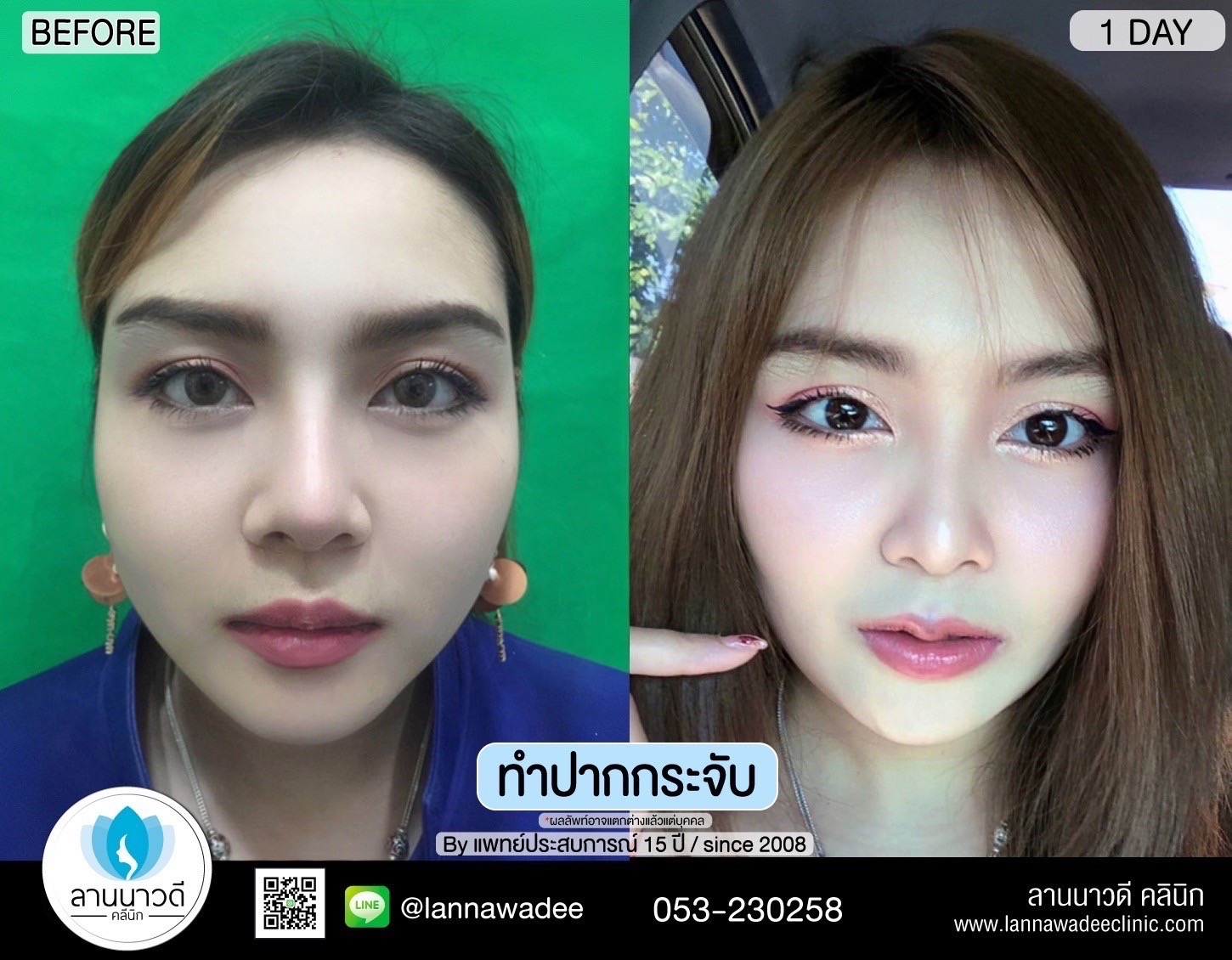 ทำปากกระจับ คืออะไร