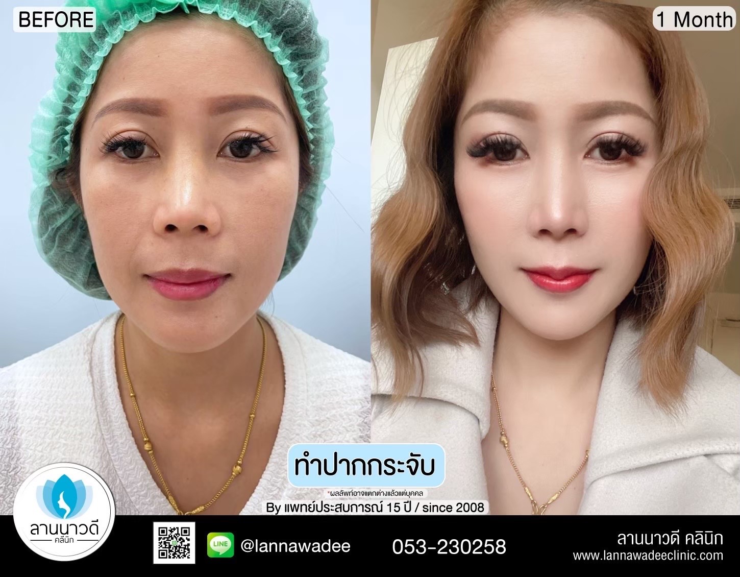 ทำปากกระจับ คืออะไร