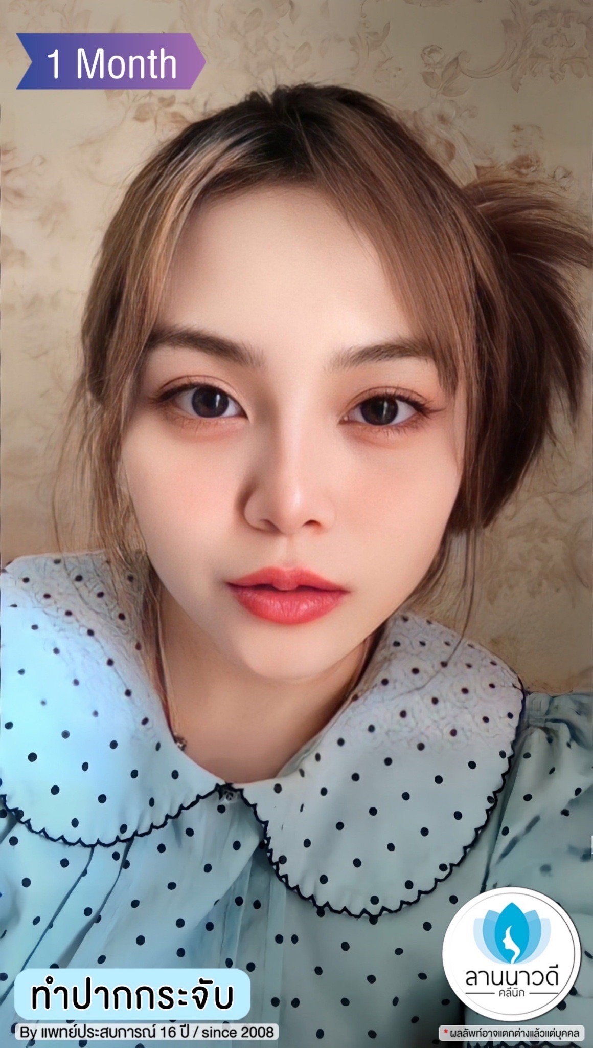 ทำปากกระจับ คืออะไร