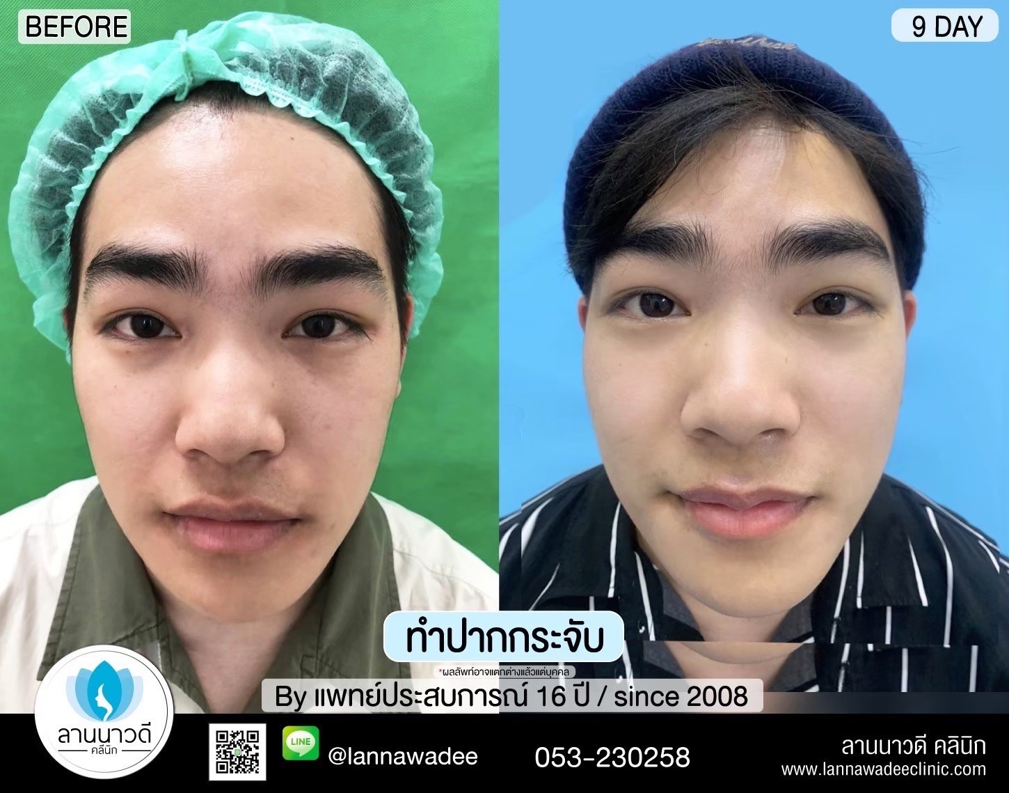 ปากกระจับ