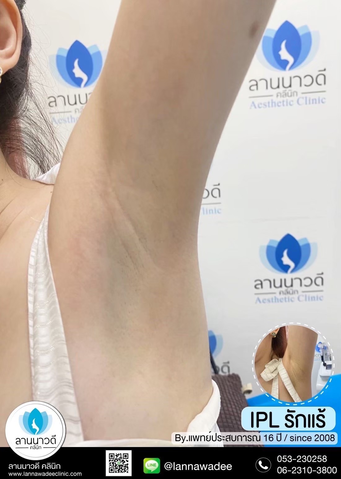 IPL คืออะไร