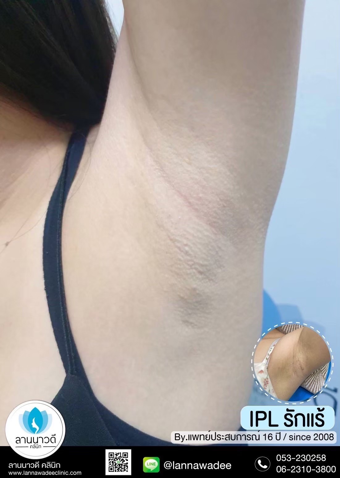 IPL คืออะไร