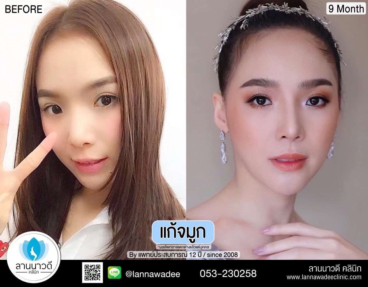 การเลือกคลินิกทำจมูกเชียงใหม่2566