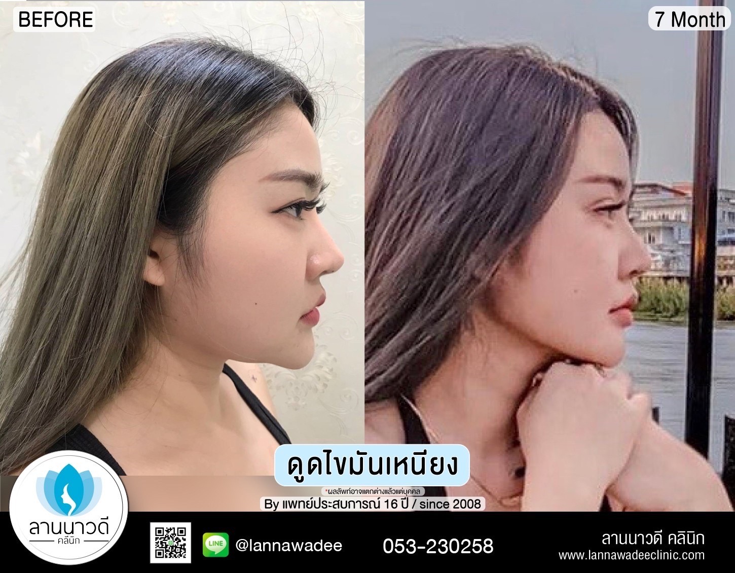 ดูดไขมันที่ไหนดี