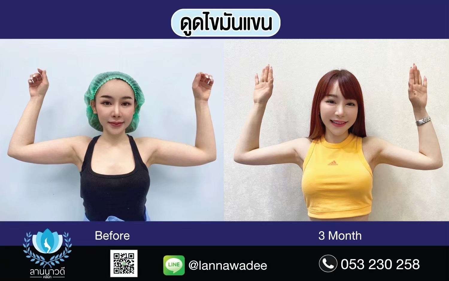 รีวิวดูดไขมัน