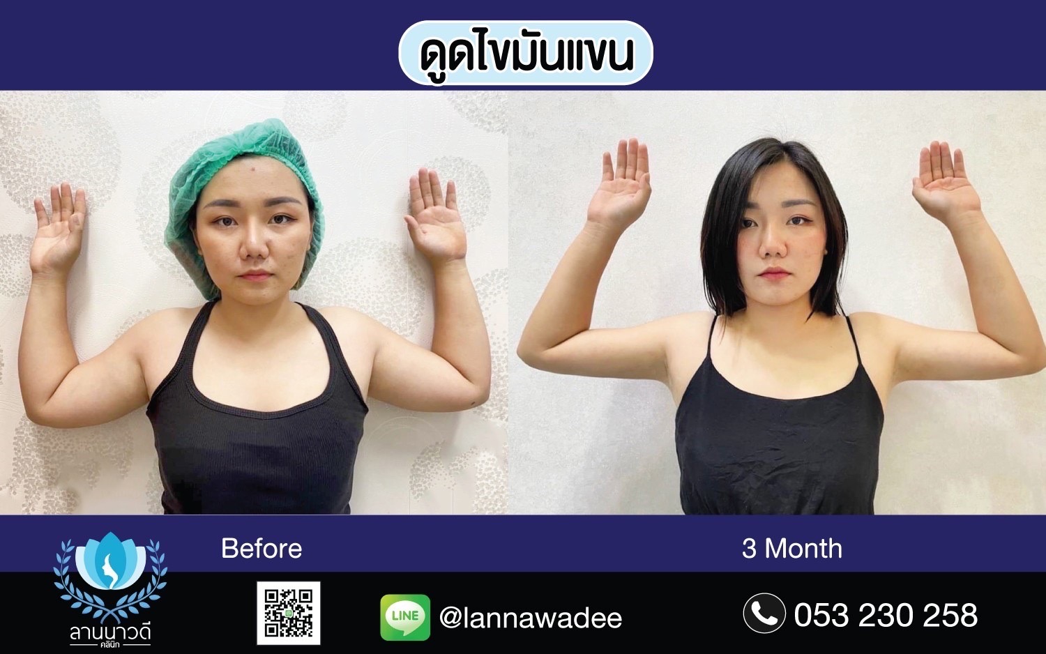 รีวิวดูดไขมัน