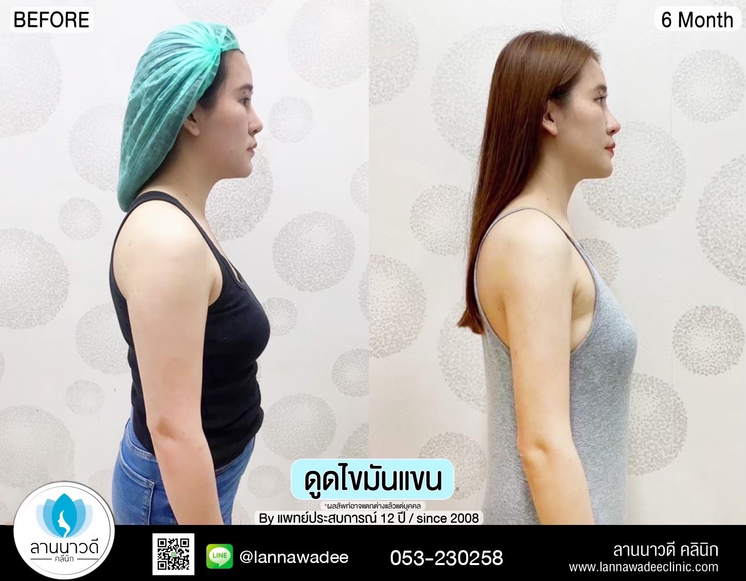 Liposuction Chiang Mai