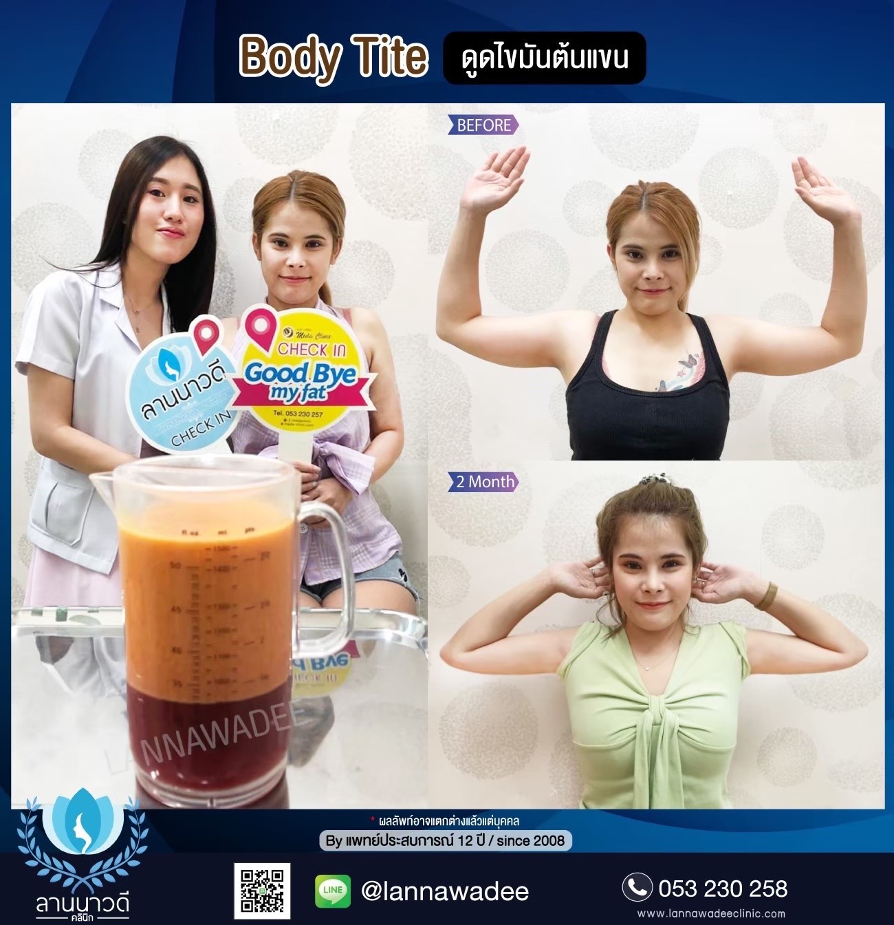 Liposuction Chiang Mai