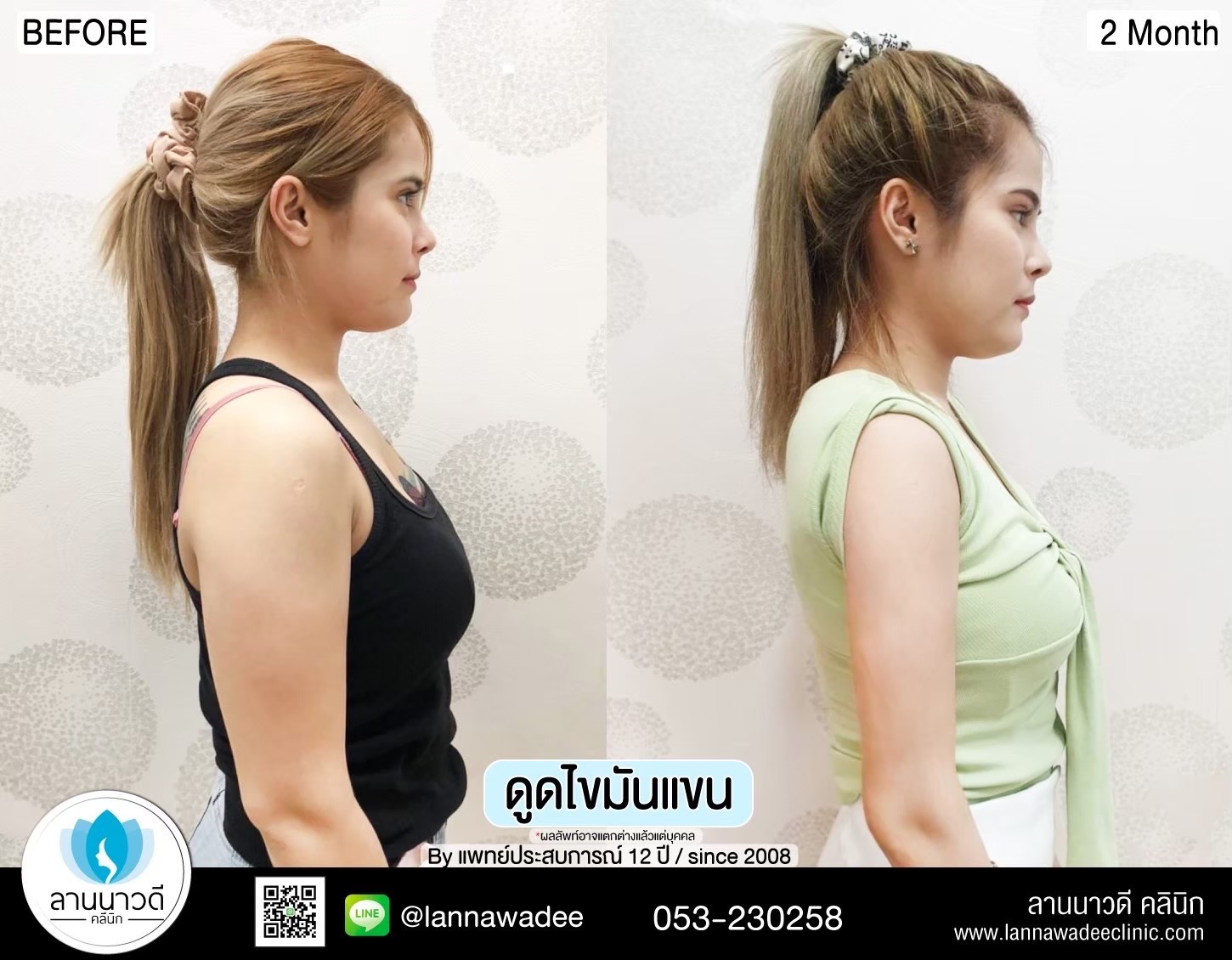 Liposuction Chiang Mai