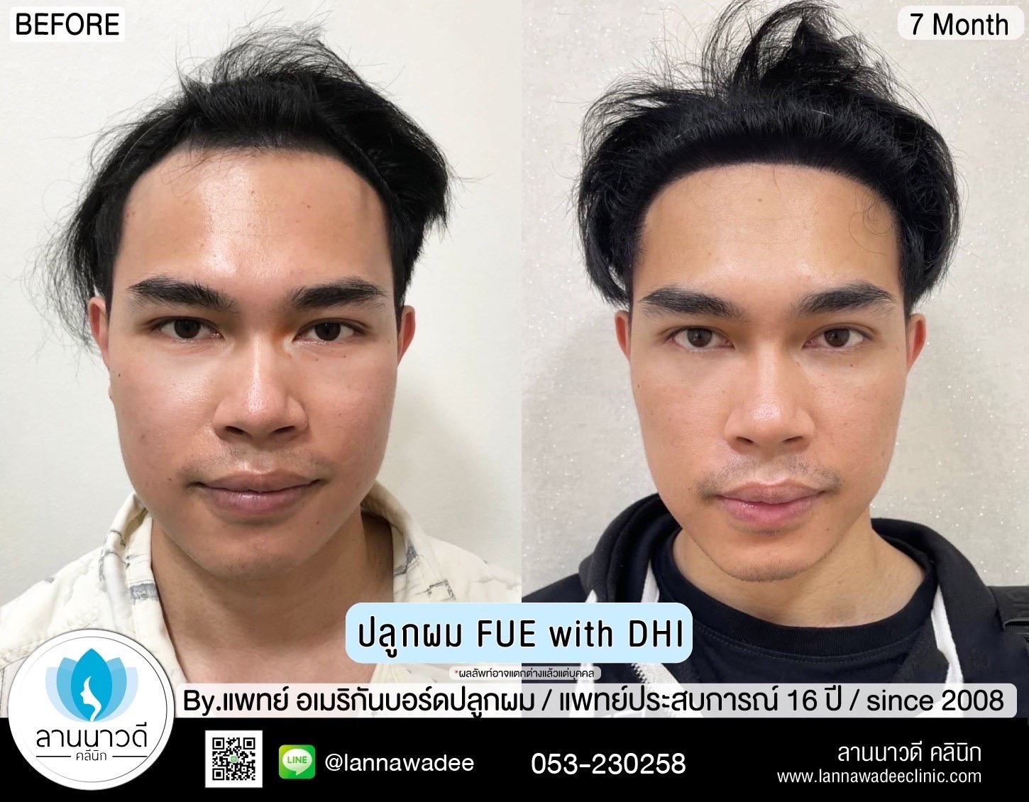 รีวิวปลูกผมเชียงใหม่