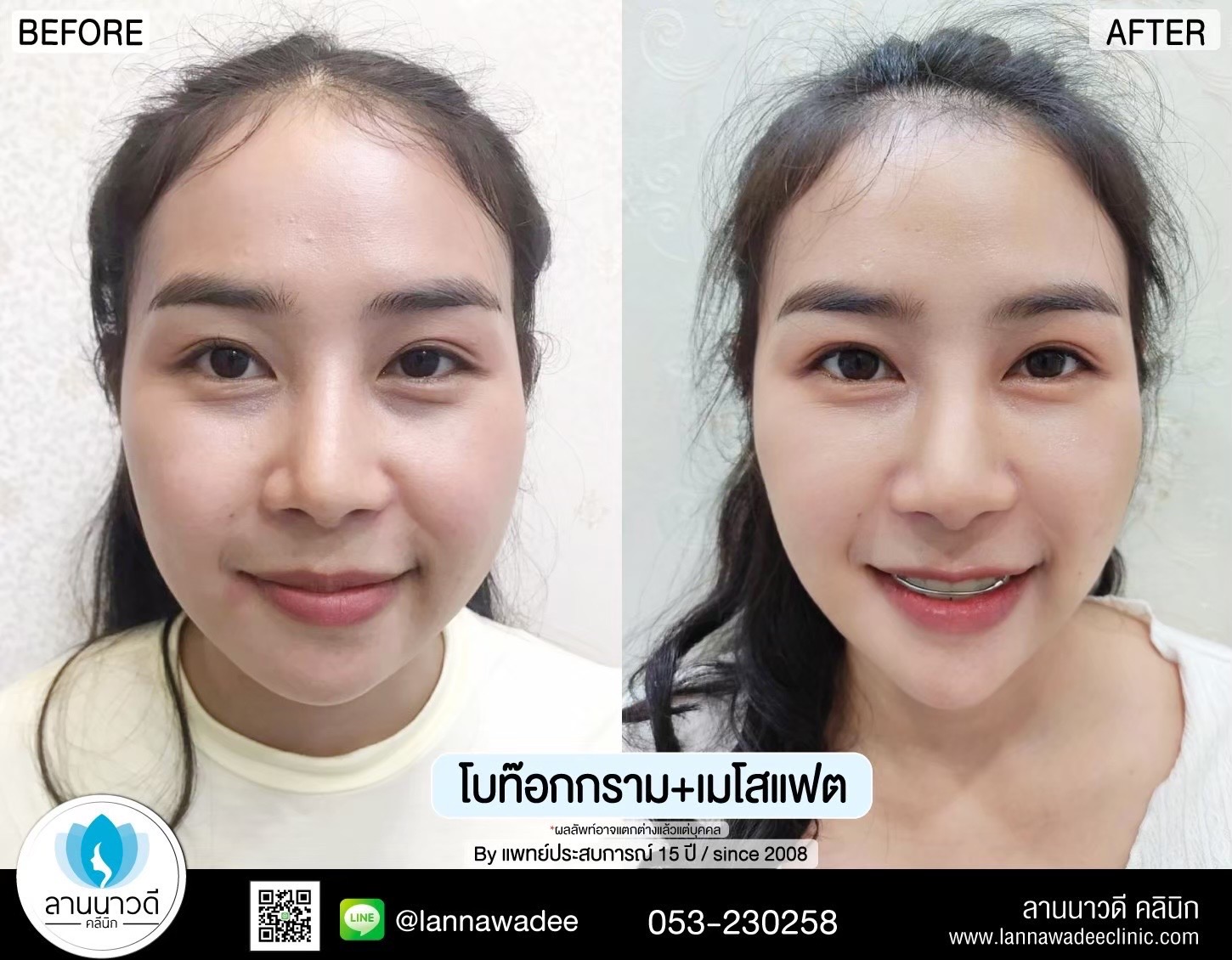 ปรับรูปหน้าที่ไหนดี เชียงใหม่