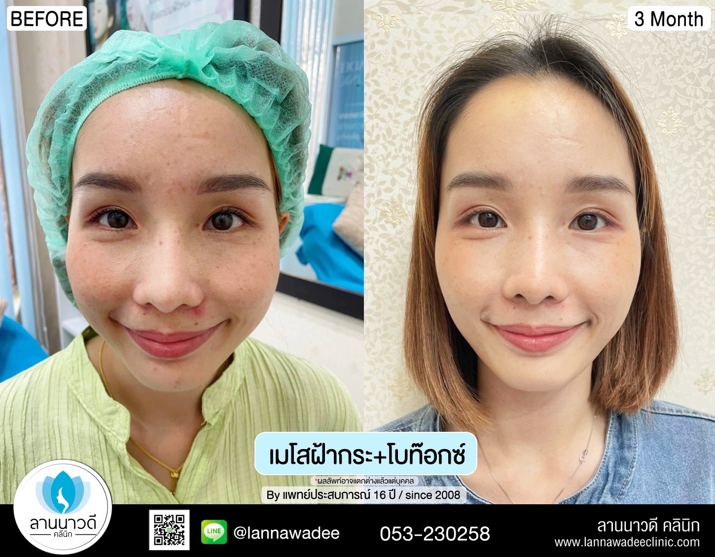 รีวิวฉีดฟิลเลอร์2566