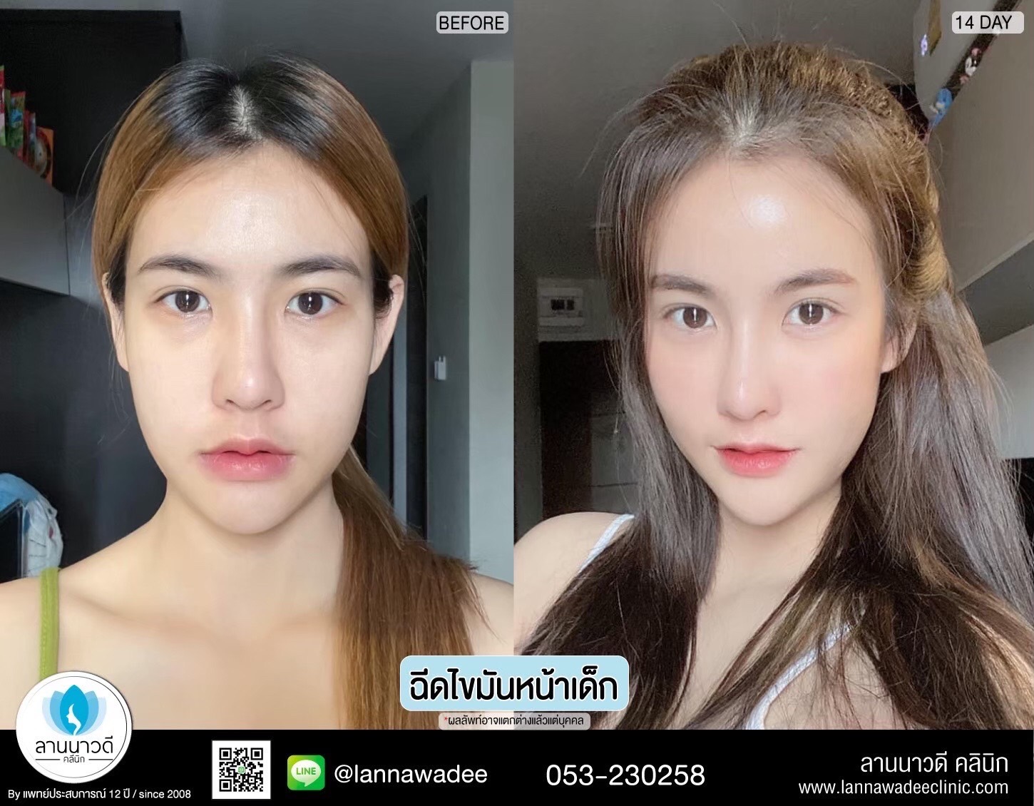 เติมไขมันหน้า