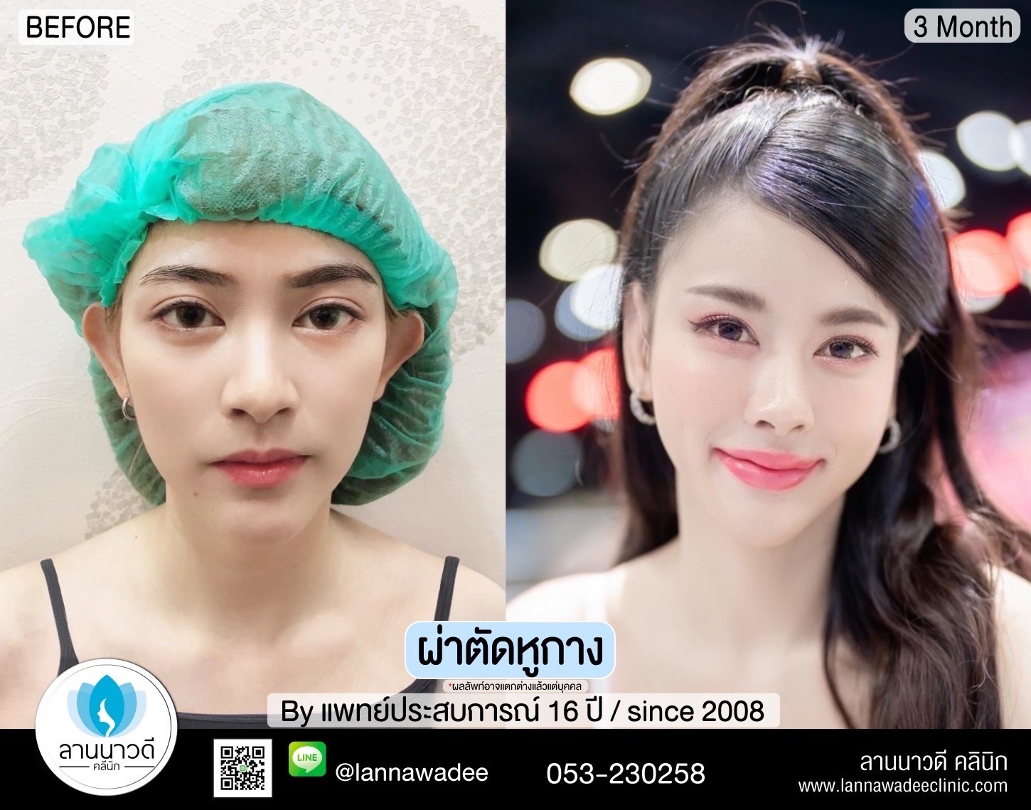 ผ่าตัดหูกาง