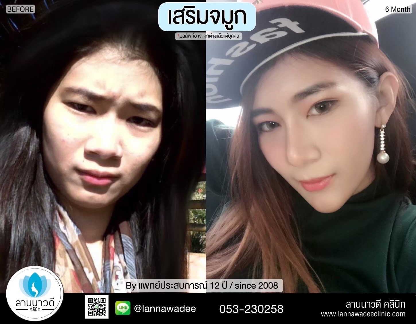 เสริมจมูกเชียงใหม่