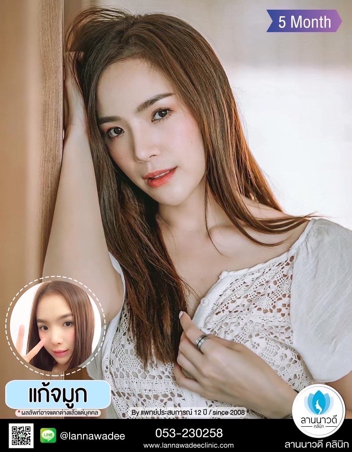 แก้จมูก แก้จมูก