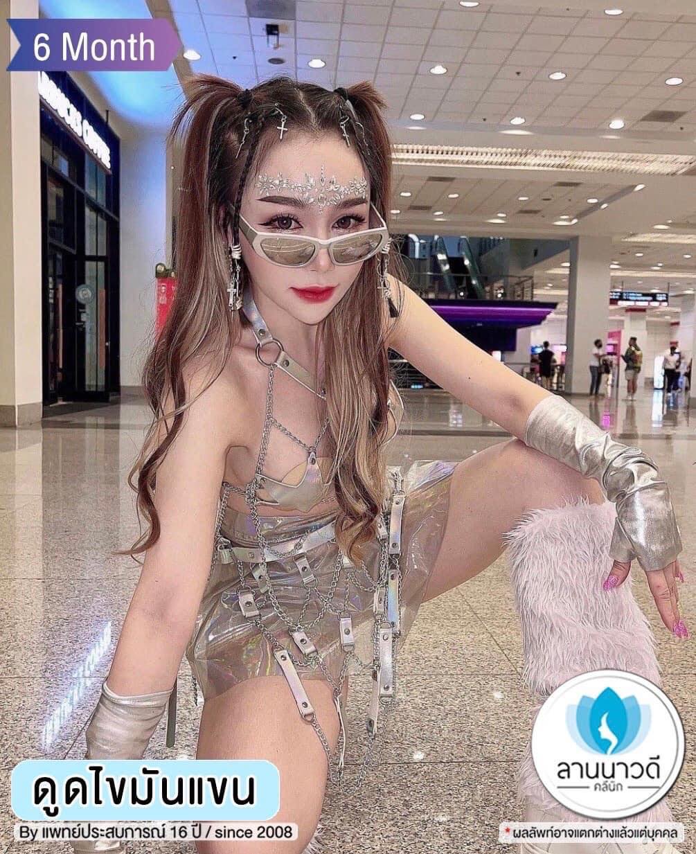 ดูดไขมันต้นแขน