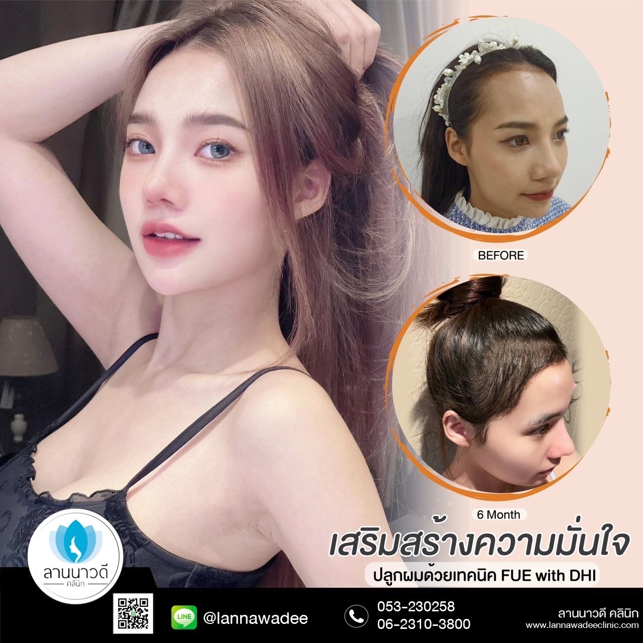 รีวิวปลูกผมเชียงใหม่