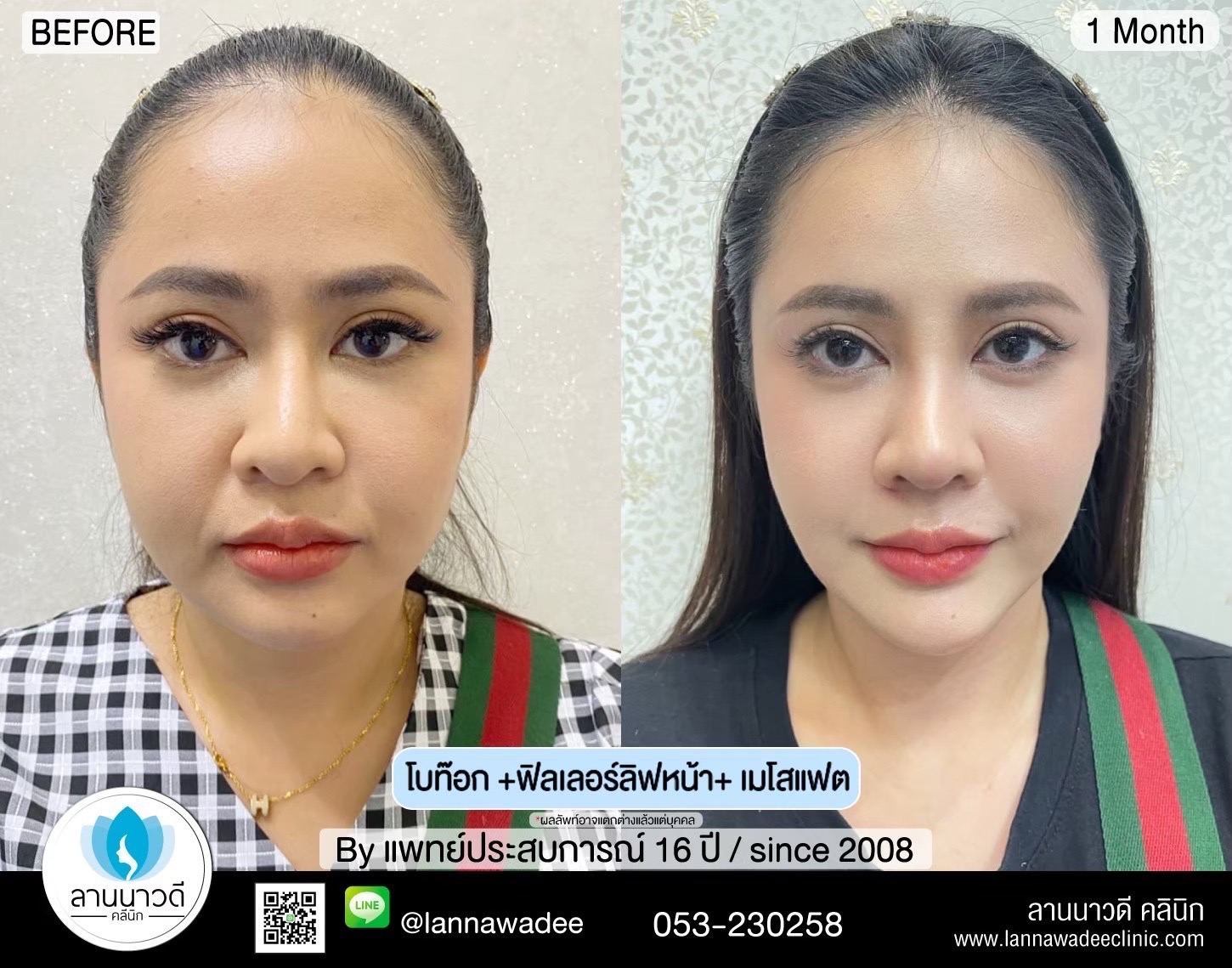 ฉีด Meso Fat เชียงใหม่