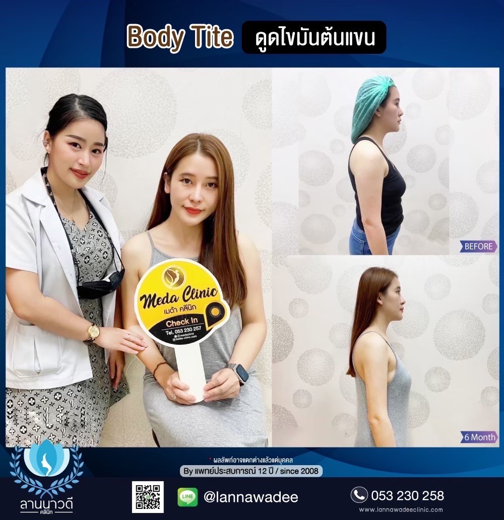ดูดไขมันแขน