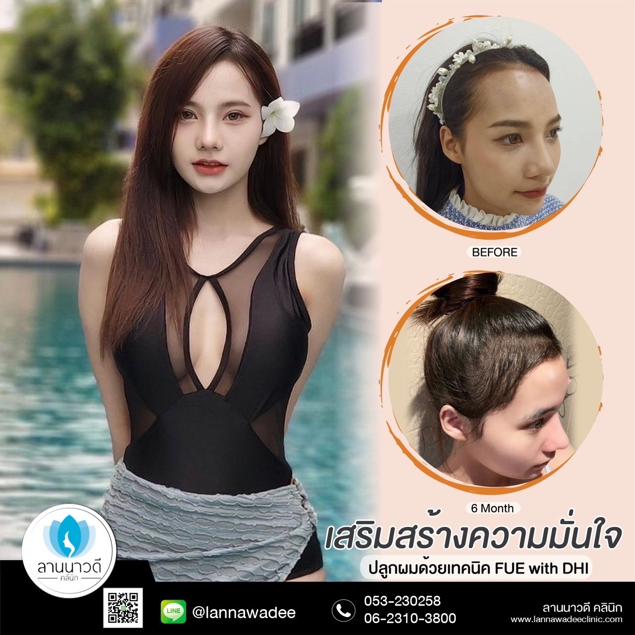 ปลูกผมถาวร