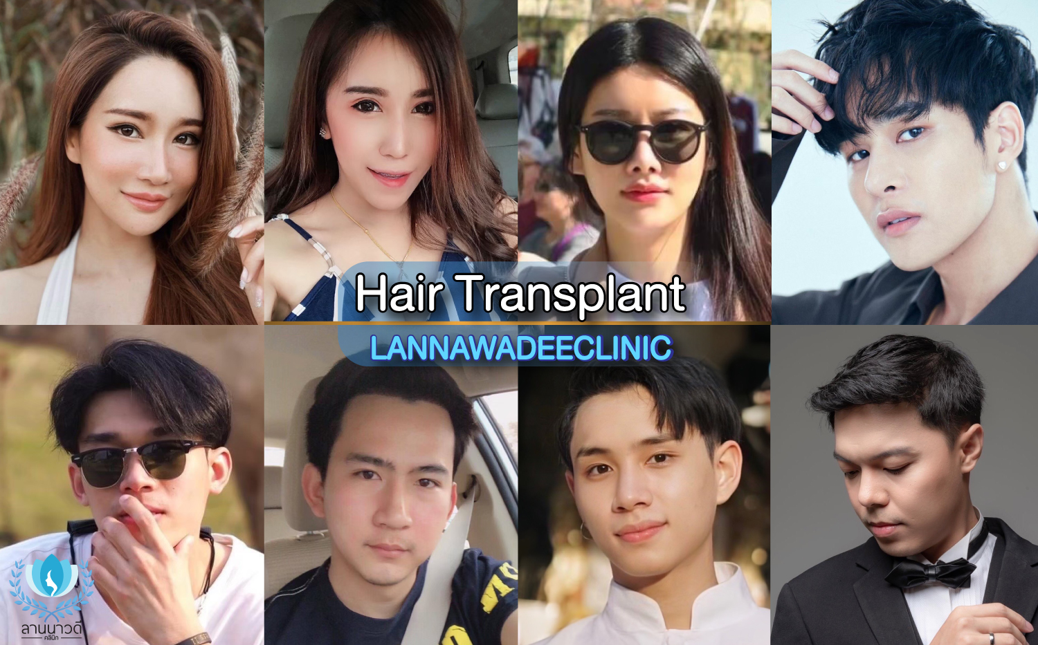 hair transplant