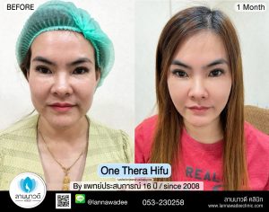 One Thera hifu