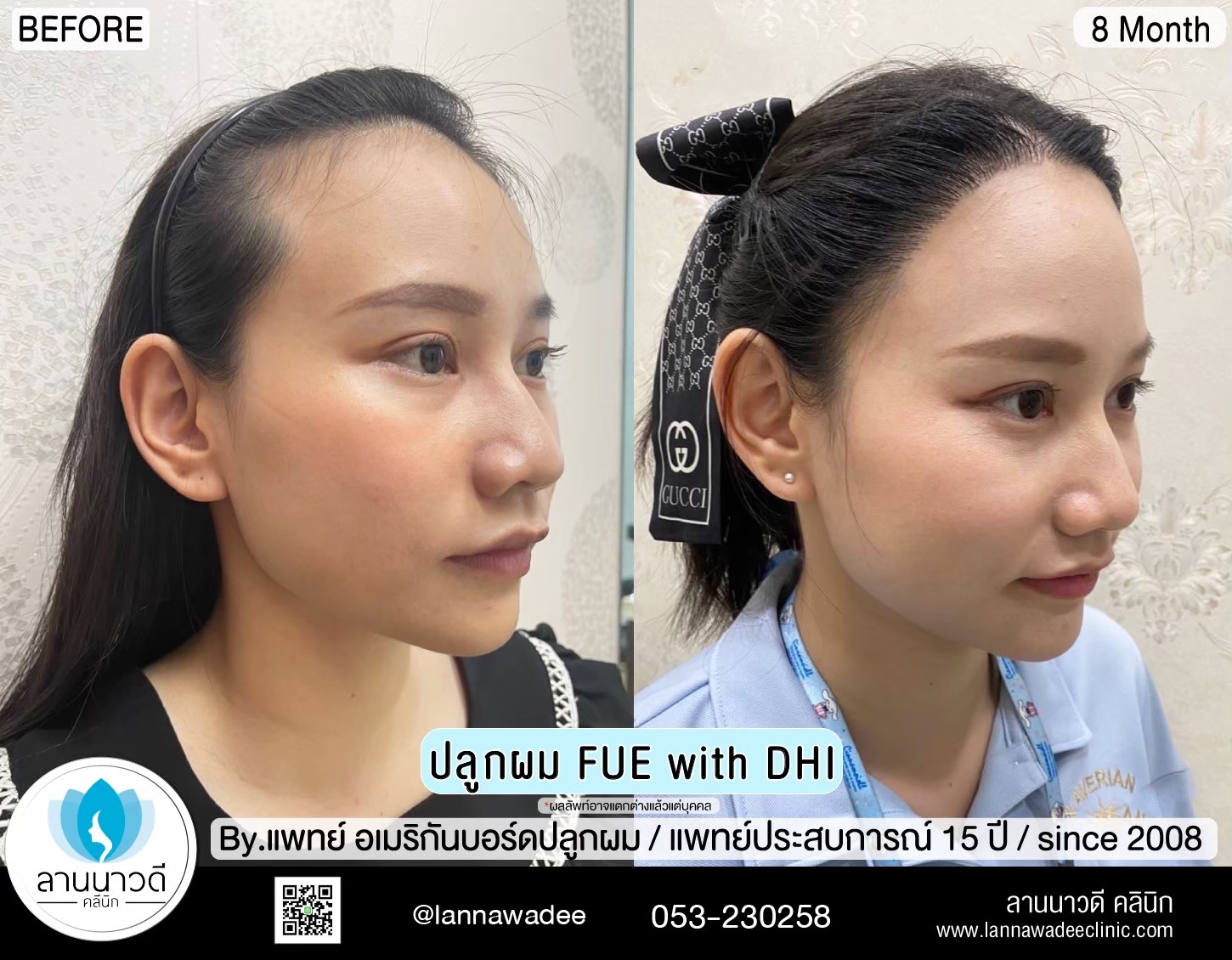 ปลูกผม