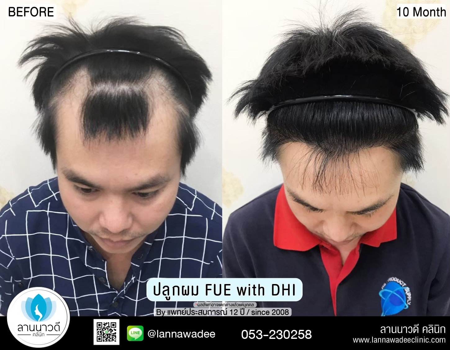 ปลูกผม