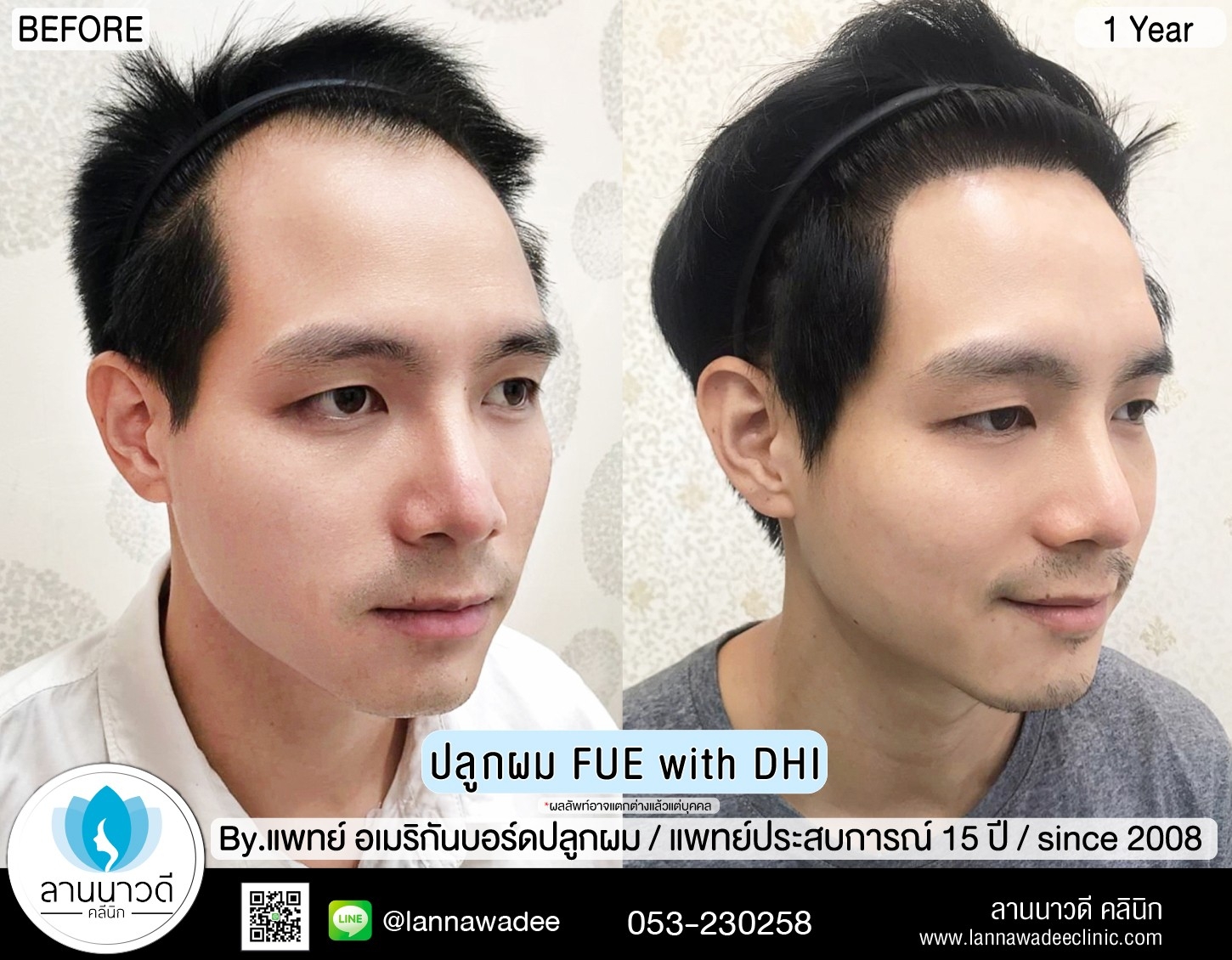ปลูกผม