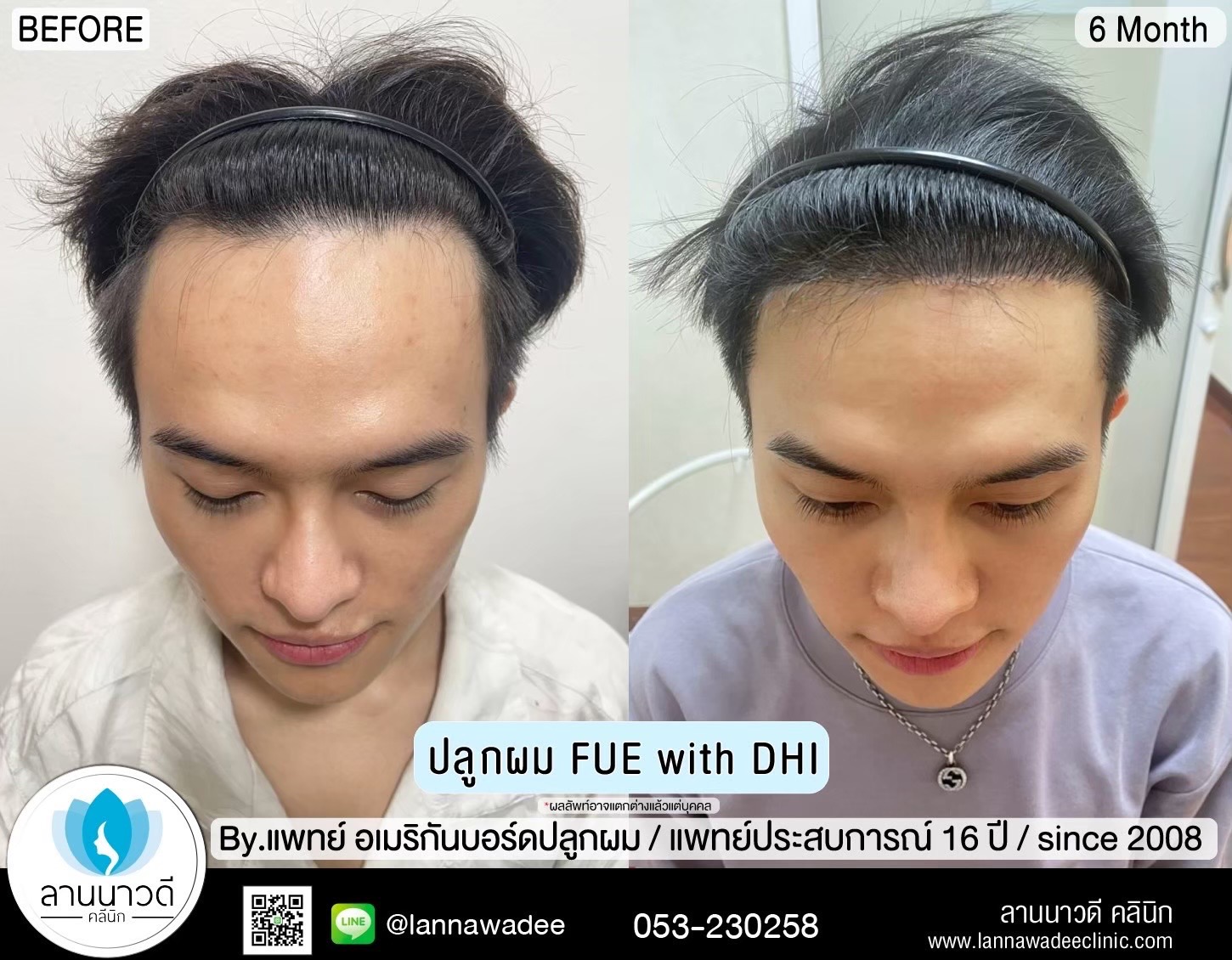 ปลูกผม