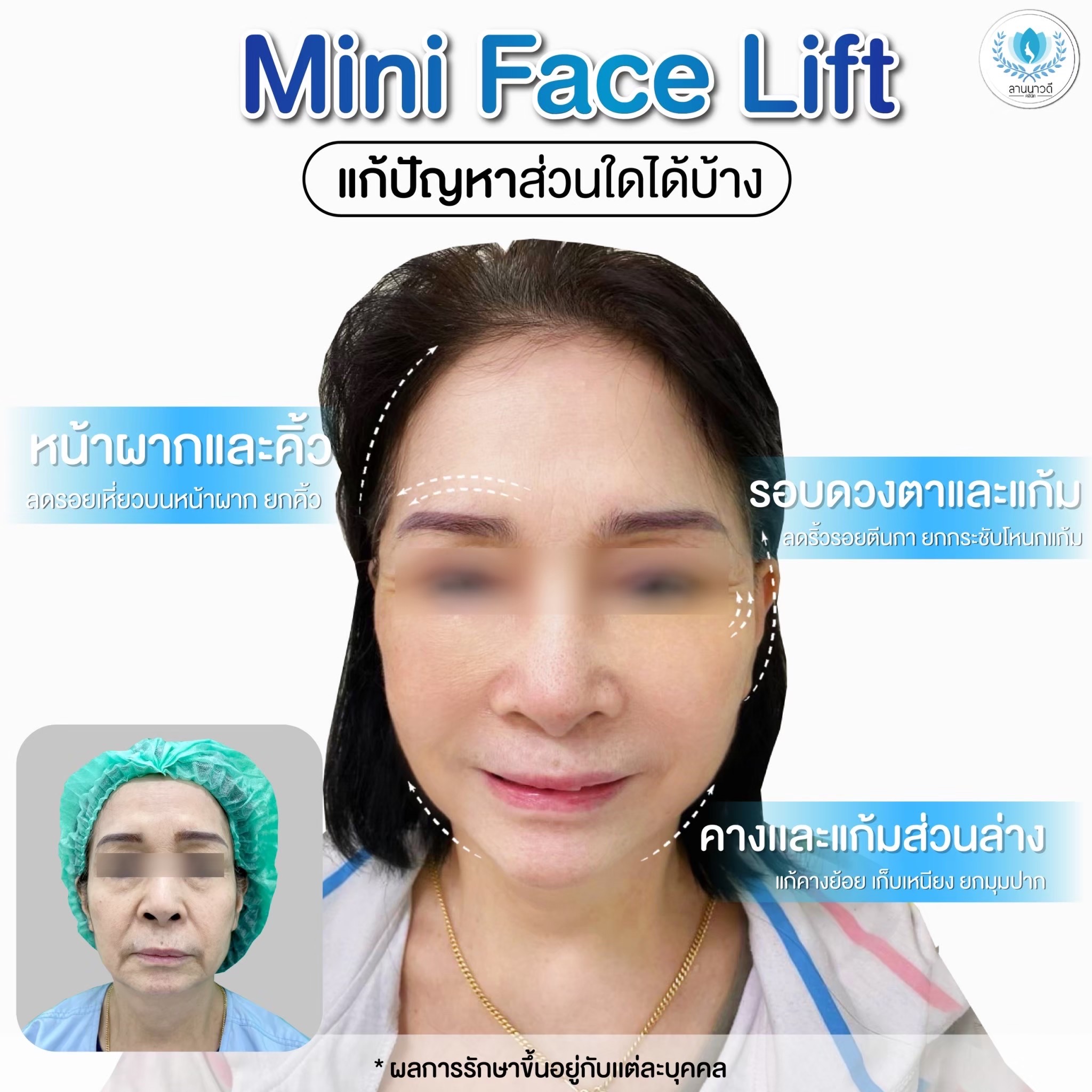 face-lift-chiangmai/