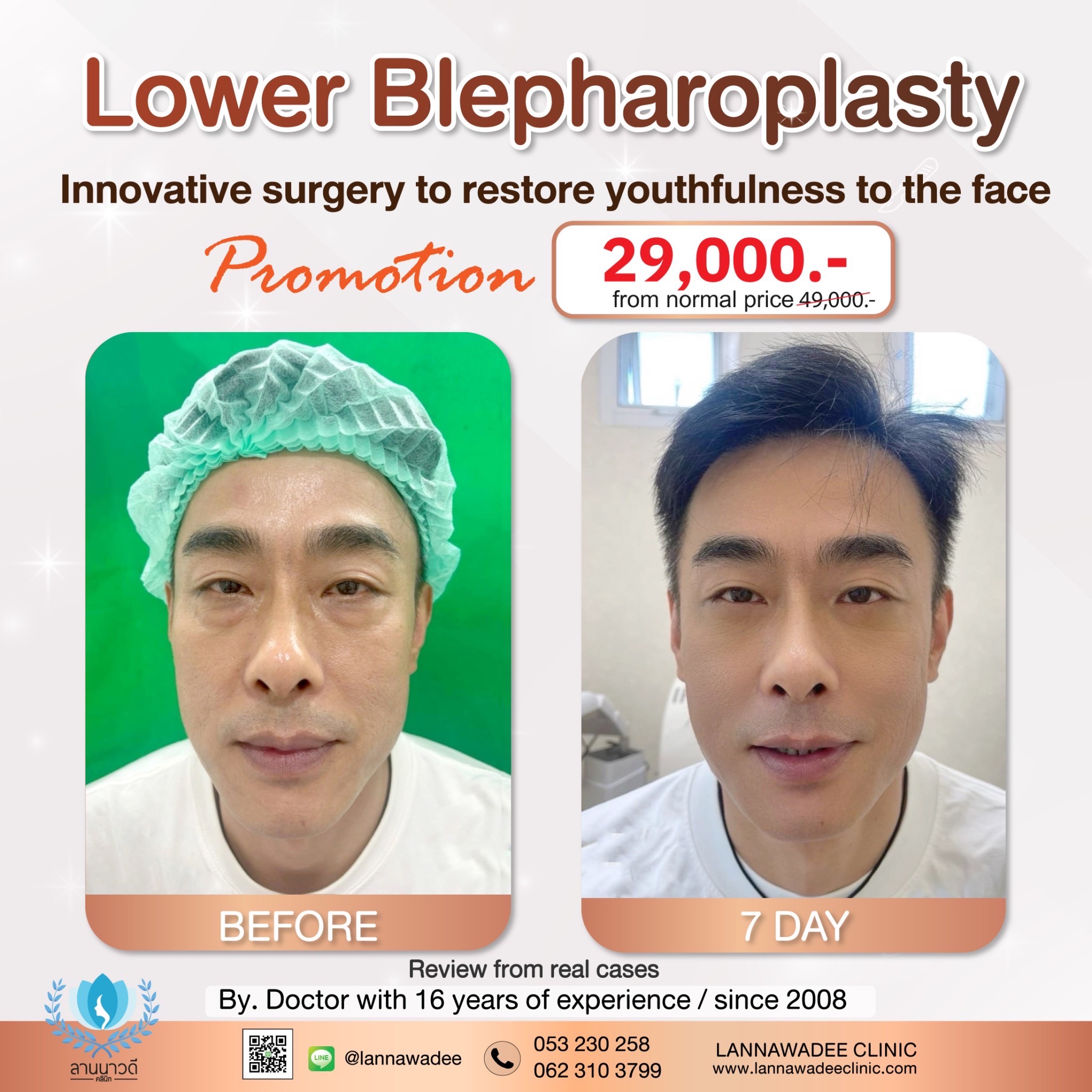 promotion lower blepharoplasty