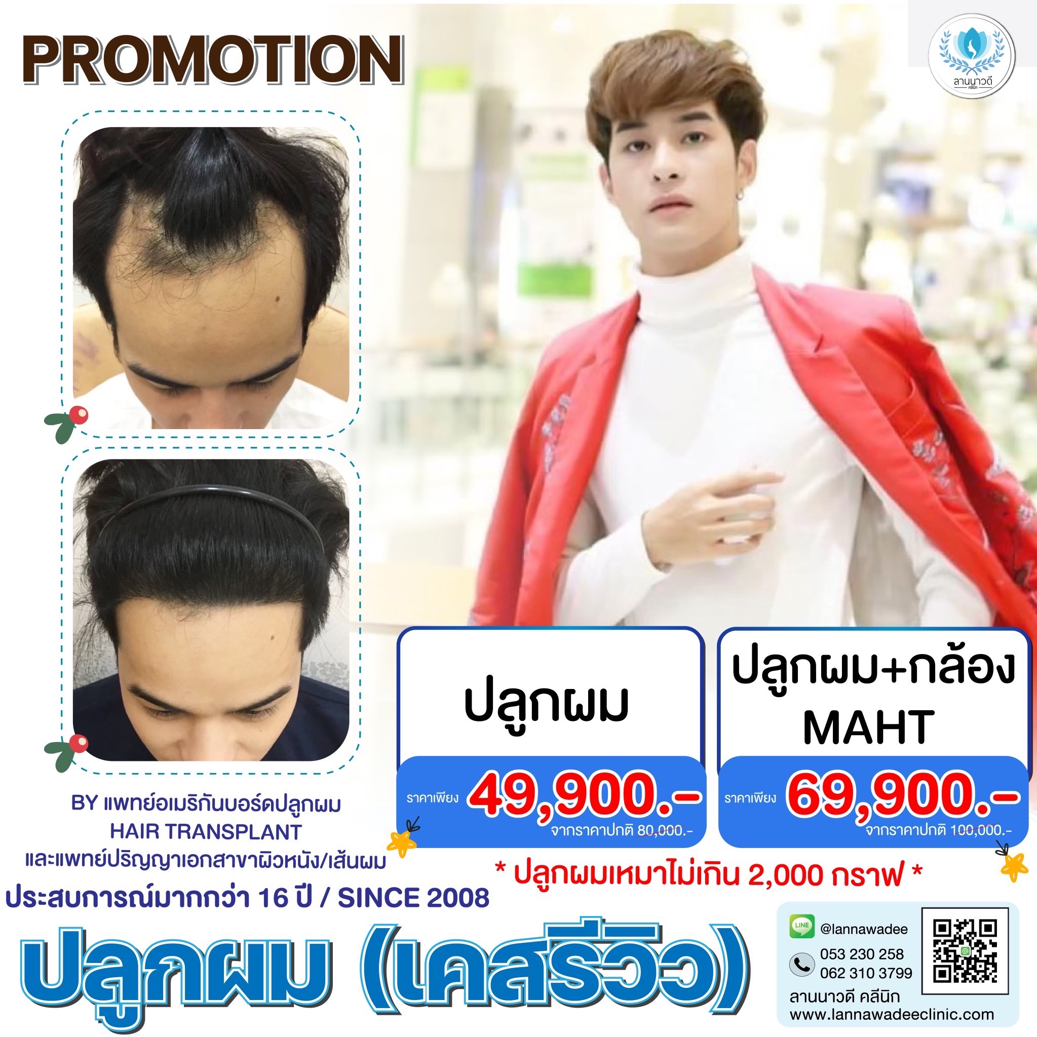 โปรโมชั่นปลูกผม