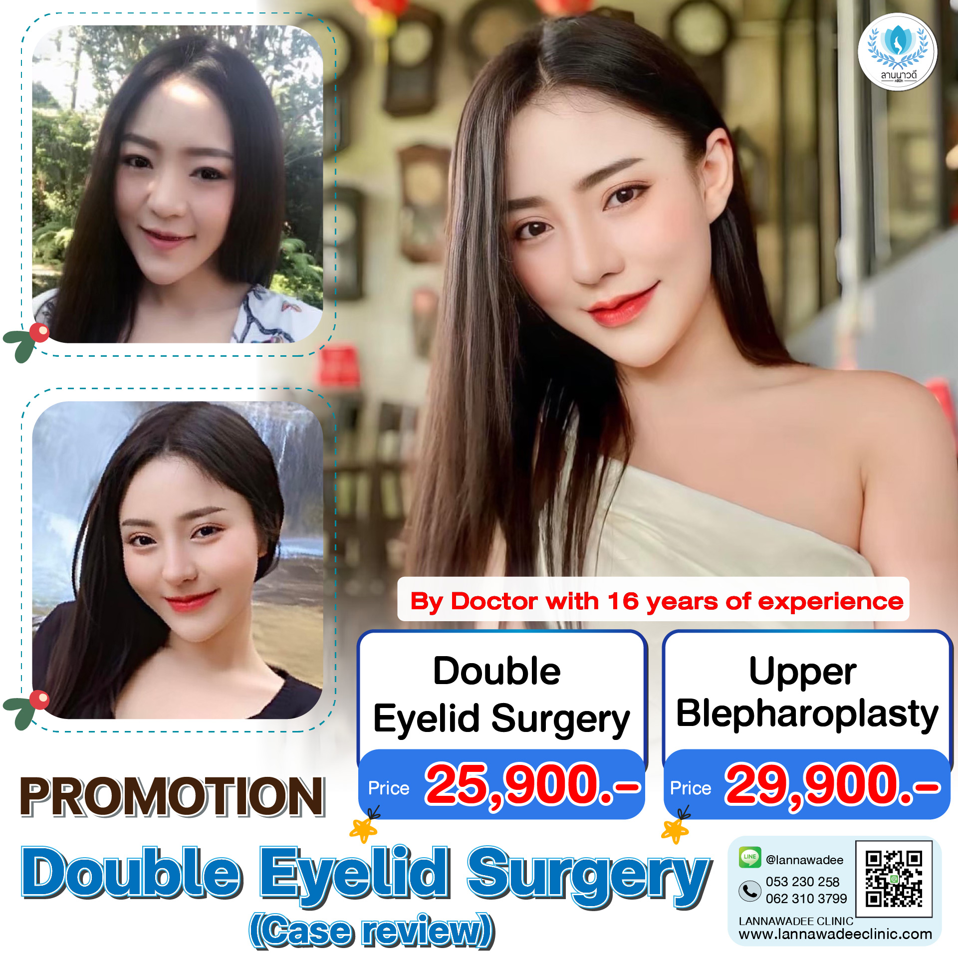 Double Eyelid Surgery Chiang Mai