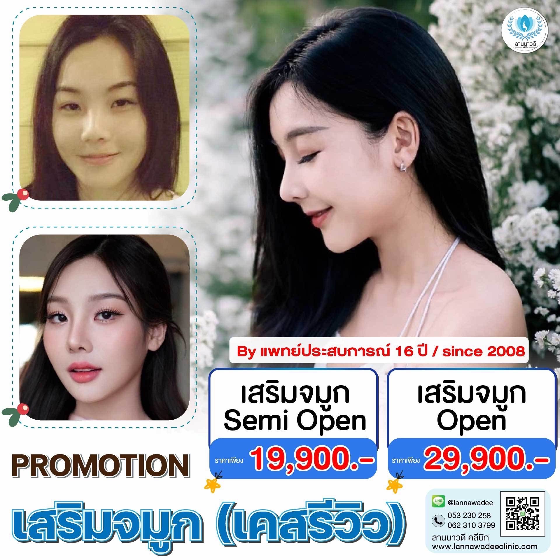 รีวิวเสริมจมูกเชียงใหม่