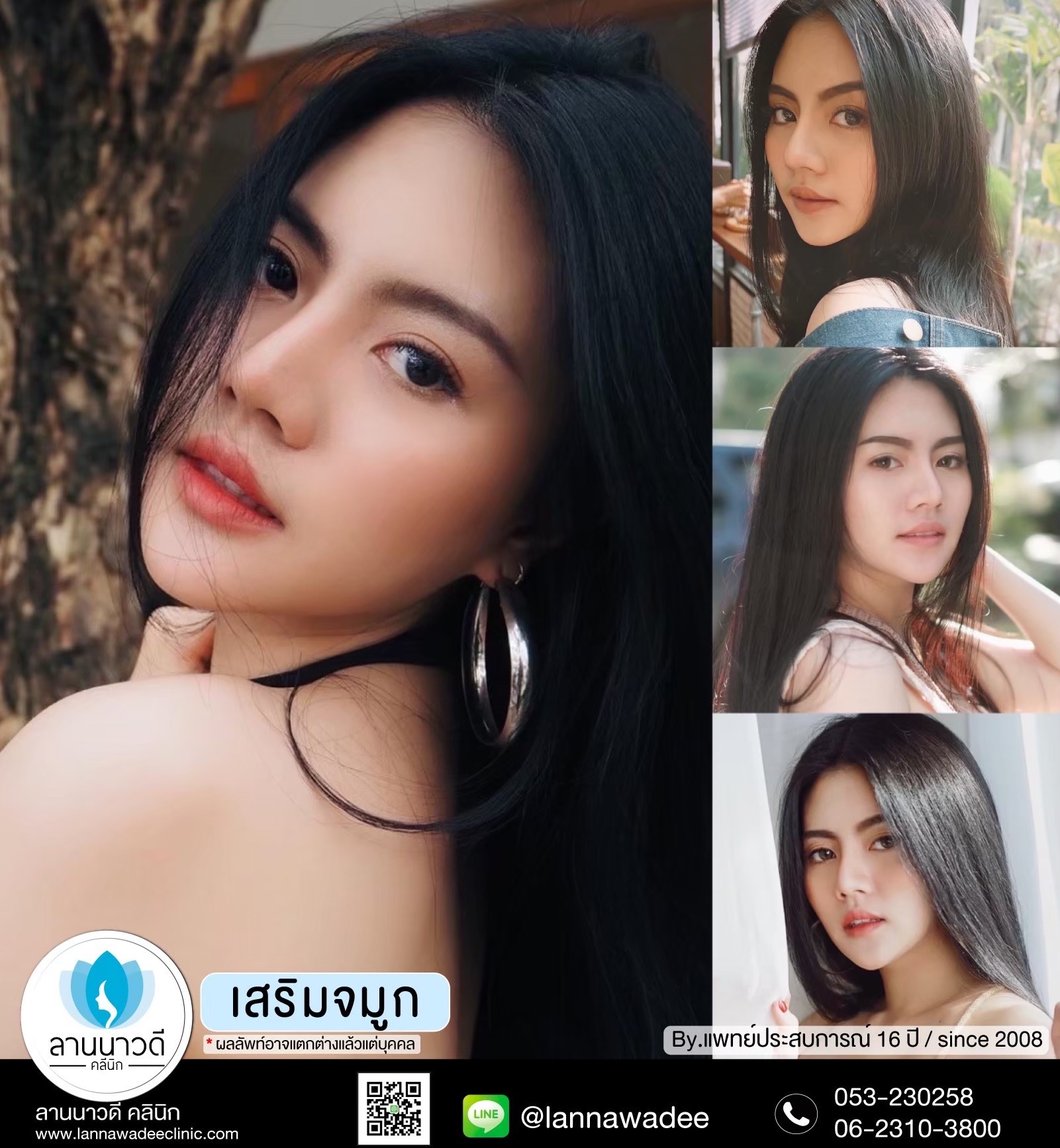 รีวิวเสริมจมูกเชียงใหม่