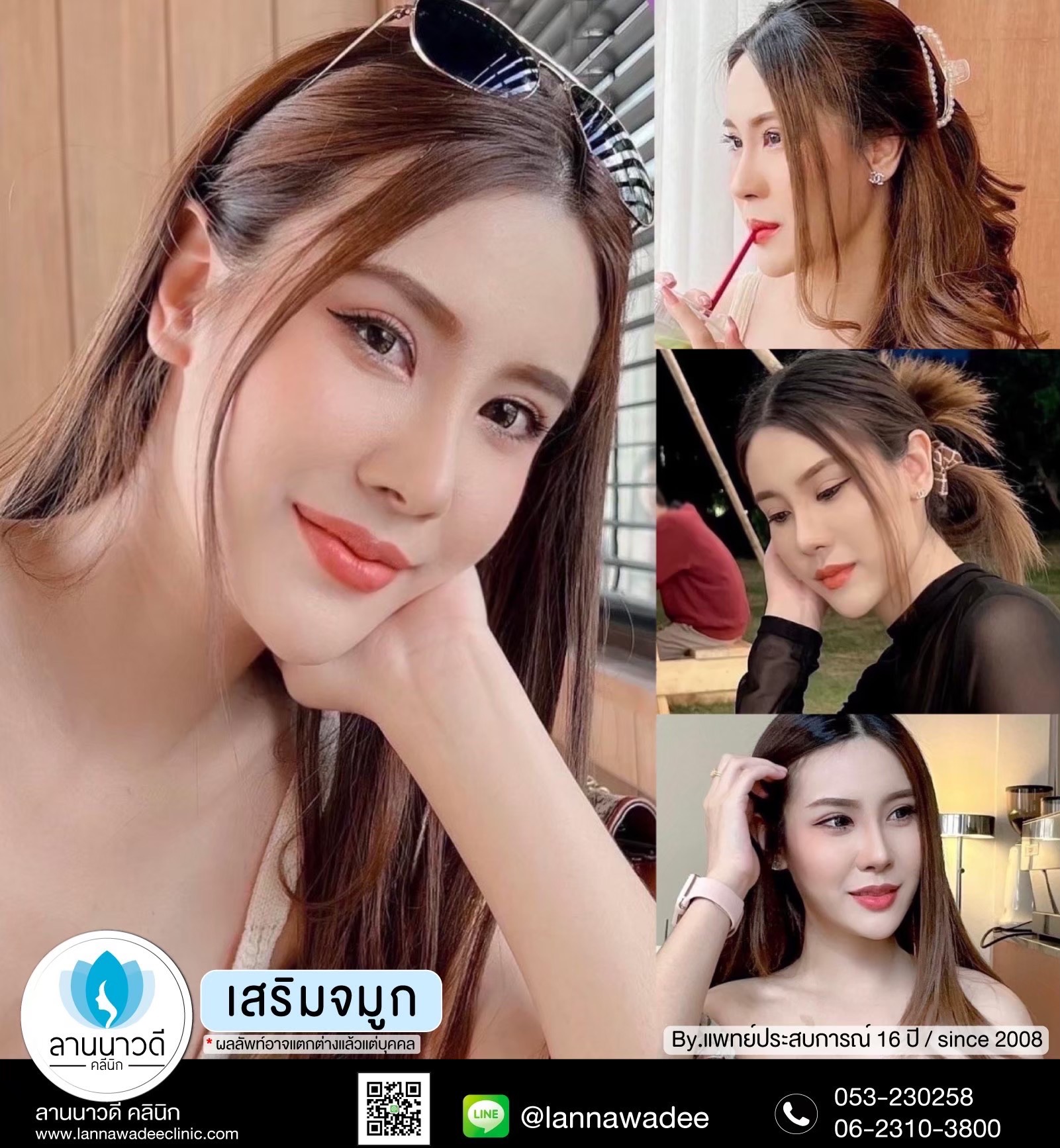 รีวิวเสริมจมูกเชียงใหม่